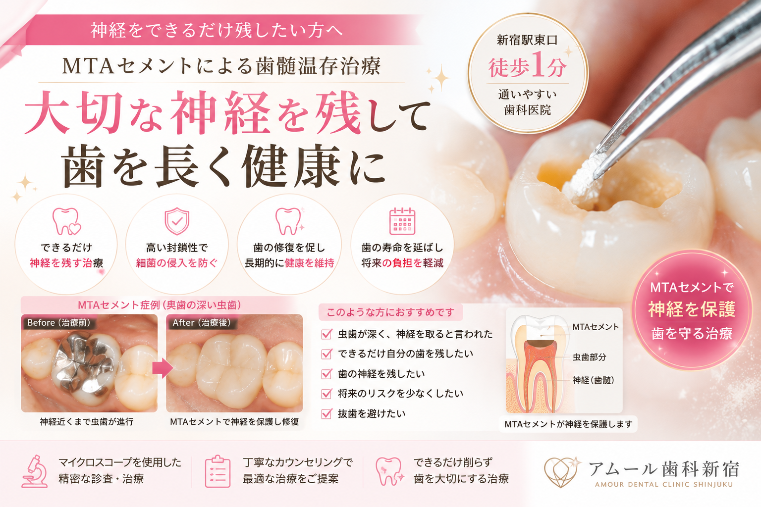 新宿でMTAセメントによる歯髄温存治療をご検討の方へ|できるだけ歯の神経を残したいならアムール歯科新宿