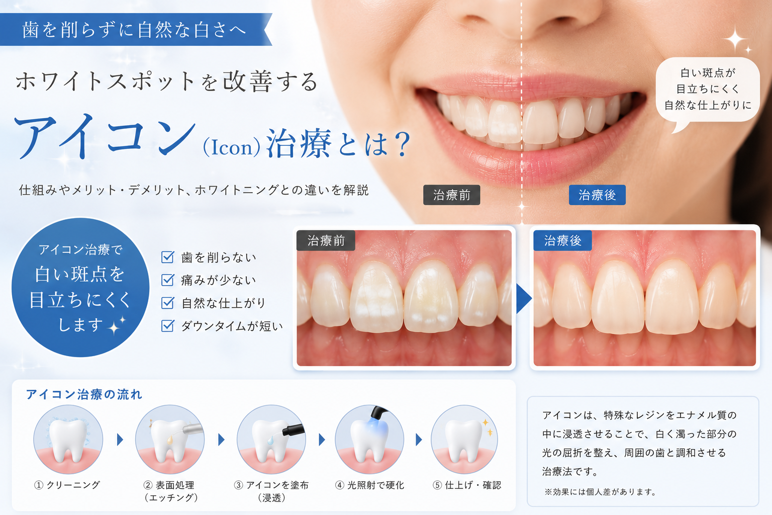 歯を削らずにホワイトスポットを改善？アイコン（Icon）治療とは｜新宿の歯医者が解説