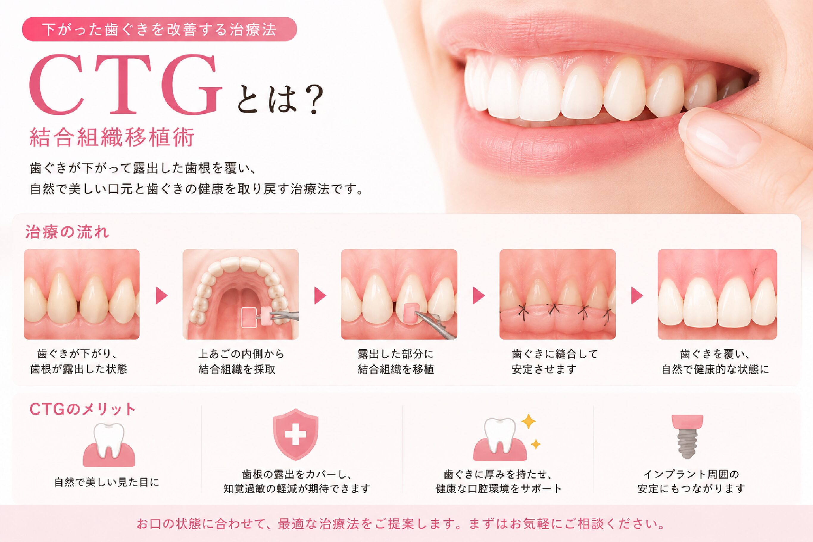 新宿でCTG（結合組織移植術）をご検討の方へ｜下がった歯ぐき・露出した歯根を改善する歯肉移植